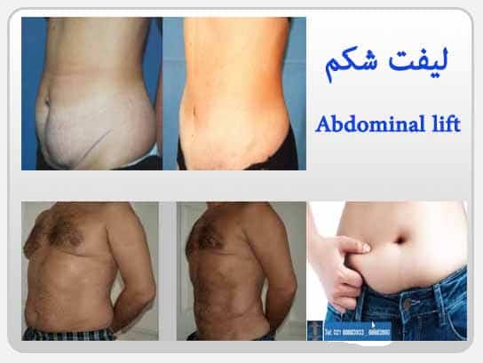 لیفت شکم